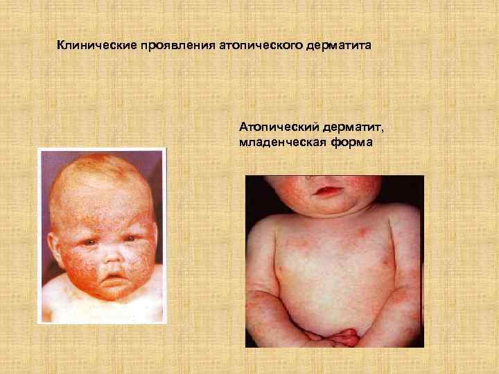 Клинические проявления атопического дерматита Атопический дерматит, младенческая форма 