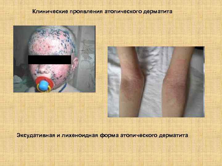 Клинические проявления атопического дерматита Эксудативная и лихеноидная форма атопического дерматита 