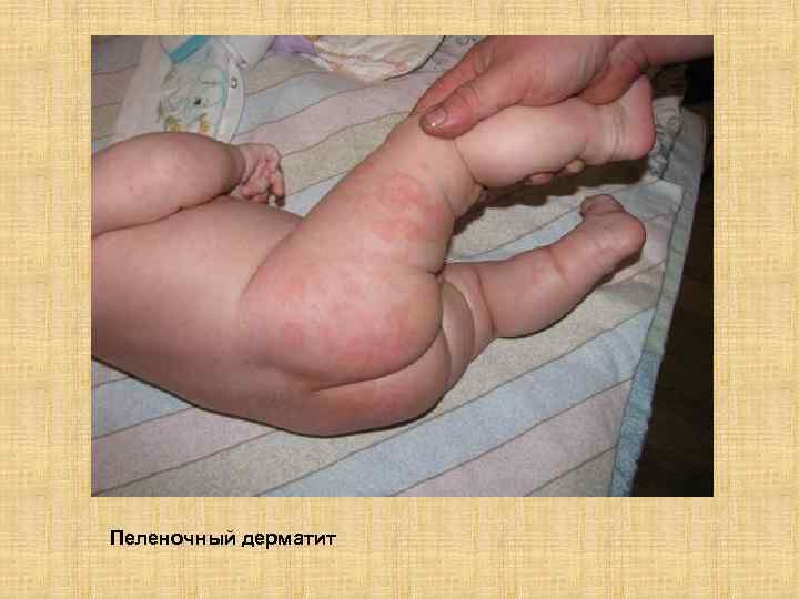 Пеленочный дерматит 