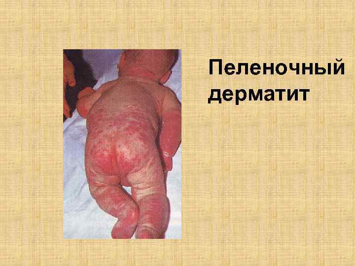 Пеленочный дерматит 