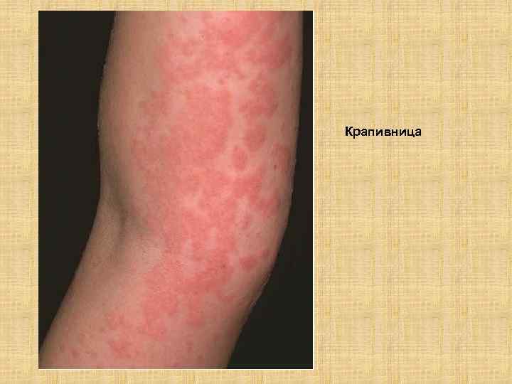 Крапивница 