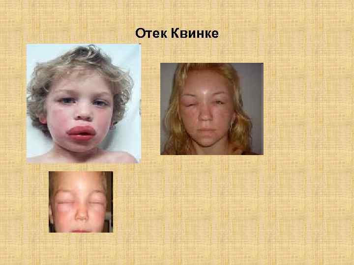 Отек Квинке 