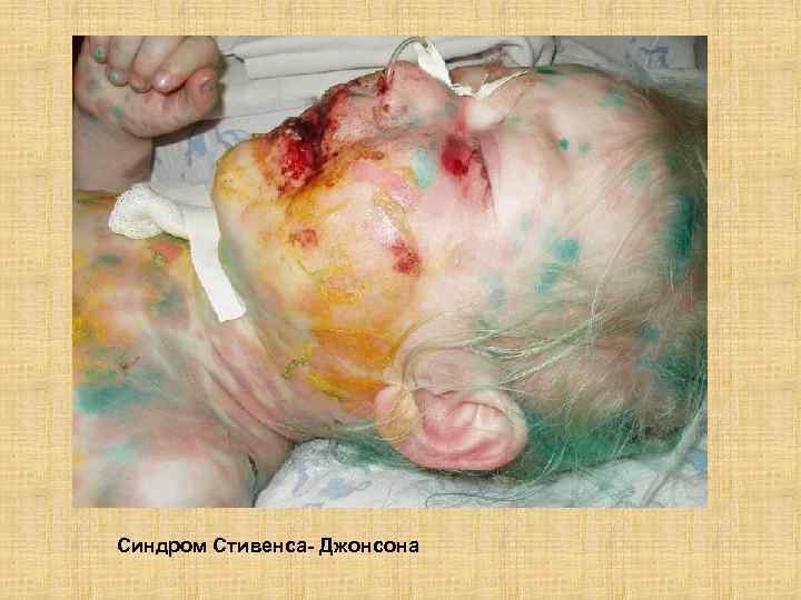 Синдром Стивенса- Джонсона 