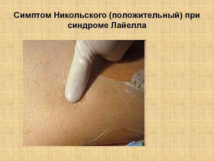 Симптом Никольского (положительный) при синдроме Лайелла 