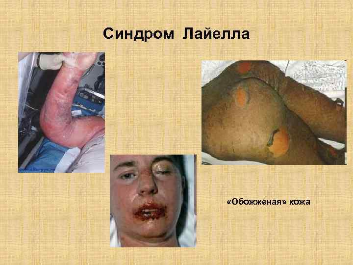 Синдром Лайелла «Обожженая» кожа 
