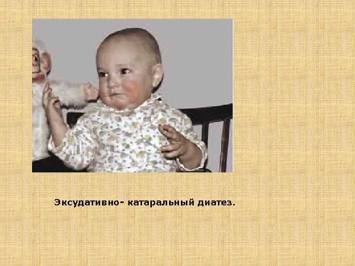 Эксудативно- катаральный диатез. 