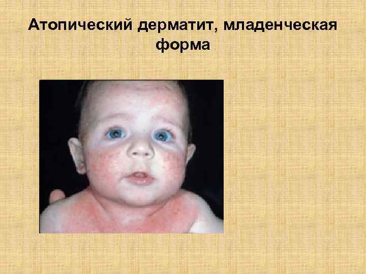 Атопический дерматит, младенческая форма 