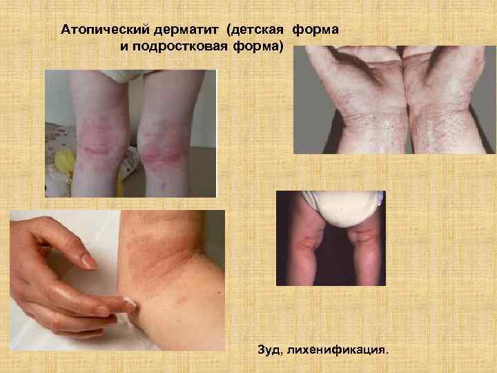 Атопический дерматит (детская форма и подростковая форма) Зуд, лихенификация. 