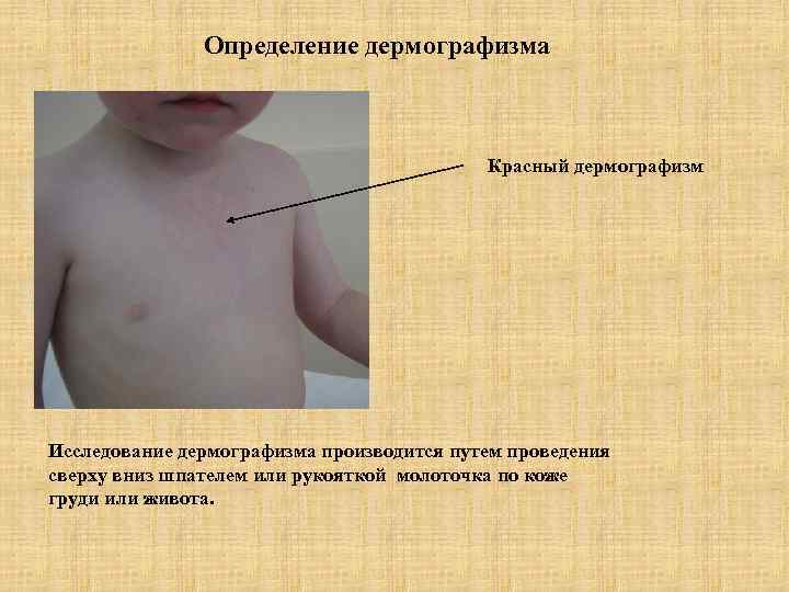 Определение дермографизма Красный дермографизм Исследование дермографизма производится путем проведения сверху вниз шпателем или рукояткой
