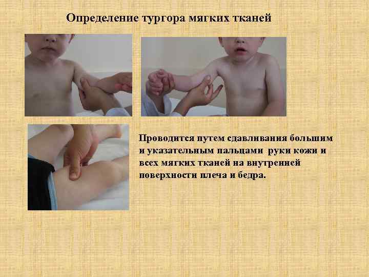 Определение тургора мягких тканей Проводится путем сдавливания большим и указательным пальцами руки кожи и