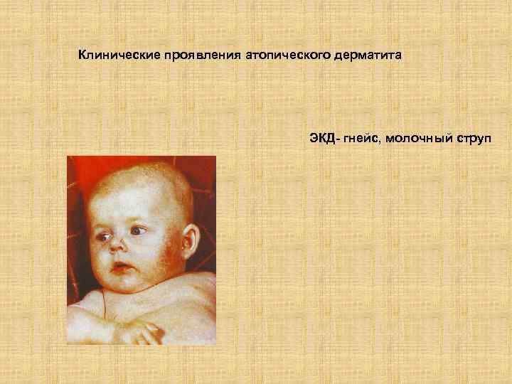 Клинические проявления атопического дерматита ЭКД- гнейс, молочный струп 