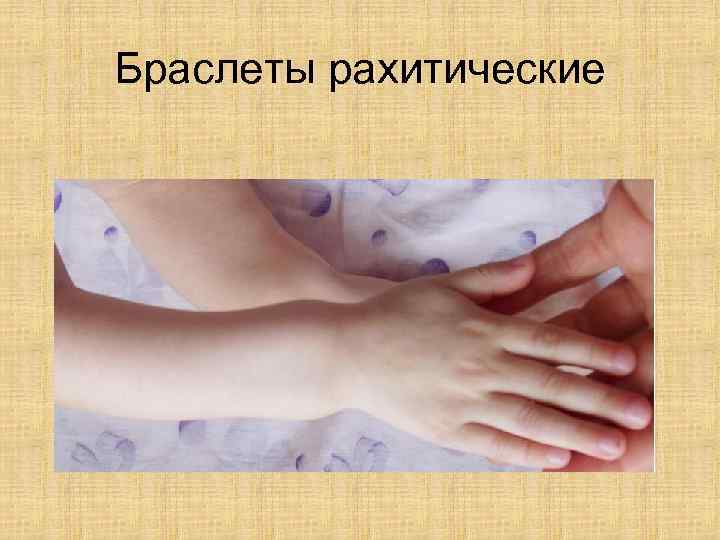 Браслеты рахитические 