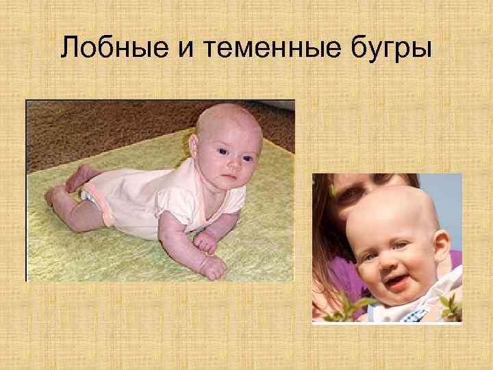 Лобные и теменные бугры 