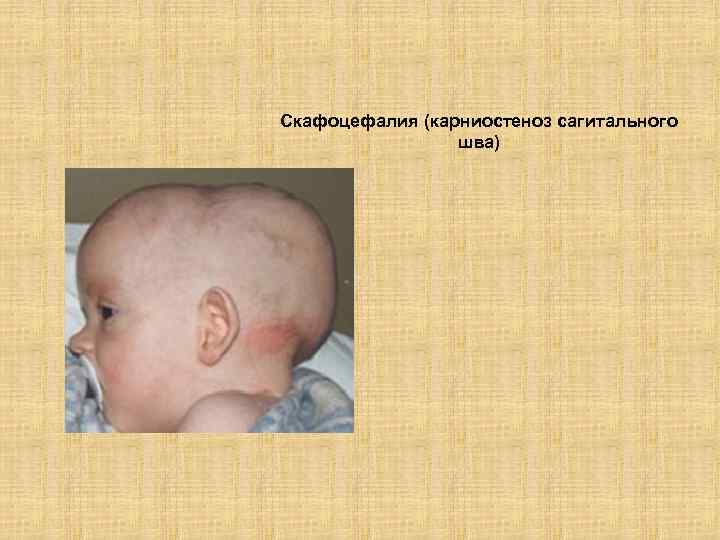 Скафоцефалия (карниостеноз сагитального шва) 