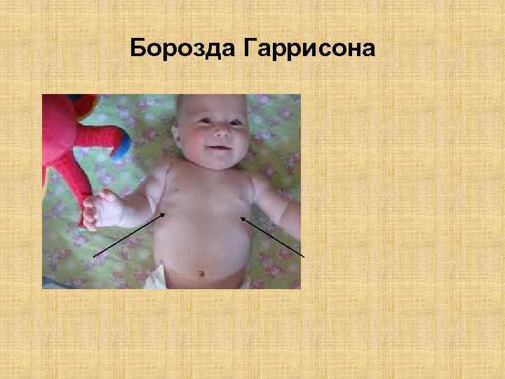 Борозда Гаррисона 