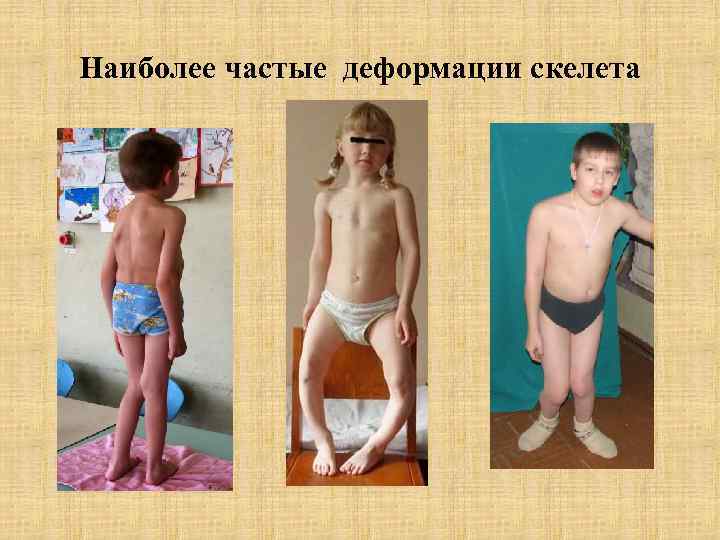Наиболее частые деформации скелета 