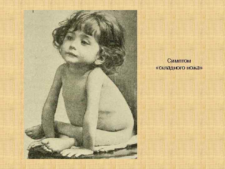 Симптом «складного ножа» 