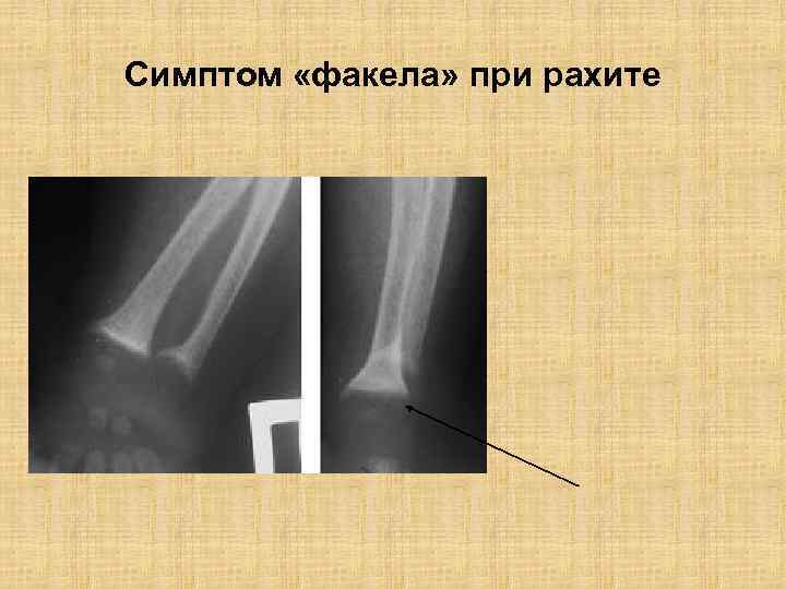 Симптом «факела» при рахите 