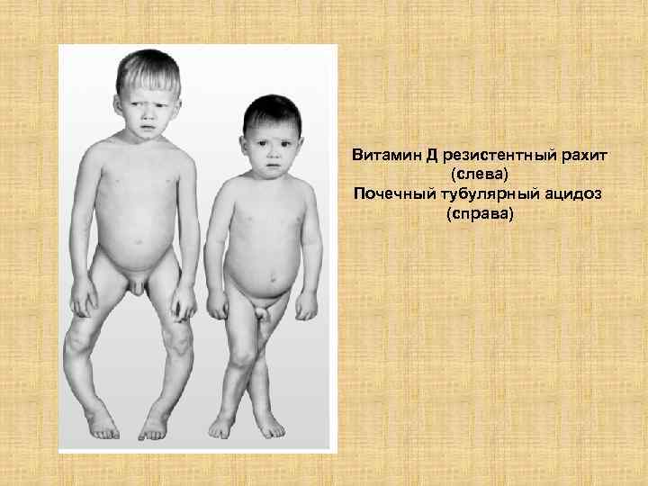 Витамин Д резистентный рахит (слева) Почечный тубулярный ацидоз (справа) 