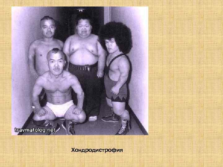 Хондродистрофия 