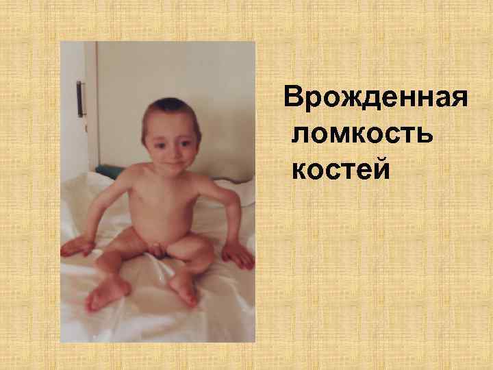 Врожденная ломкость костей 