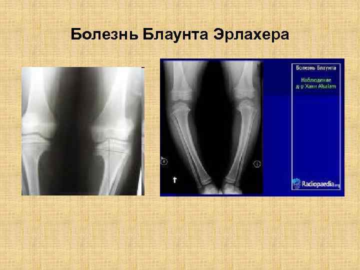 Для разгара рахита характерна следующая рентгенологическая картина