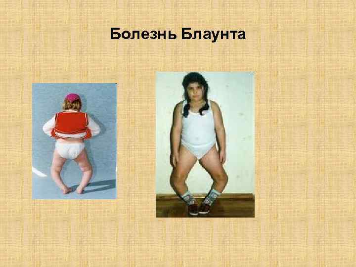 Болезнь Блаунта 