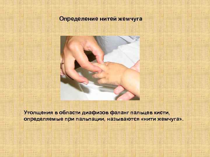 Определение нитей жемчуга Утолщения в области диафизов фаланг пальцев кисти, определяемые при пальпации, называются