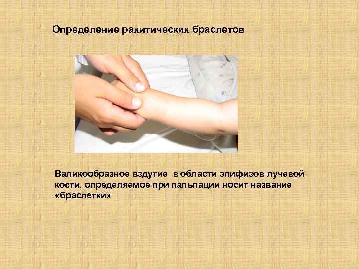 Определение рахитических браслетов Валикообразное вздутие в области эпифизов лучевой кости, определяемое при пальпации носит