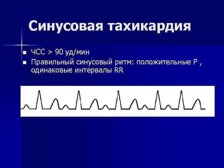 Синусовая тахикардия n n ЧСС > 90 уд/мин Правильный синусовый ритм: положительные Р ,