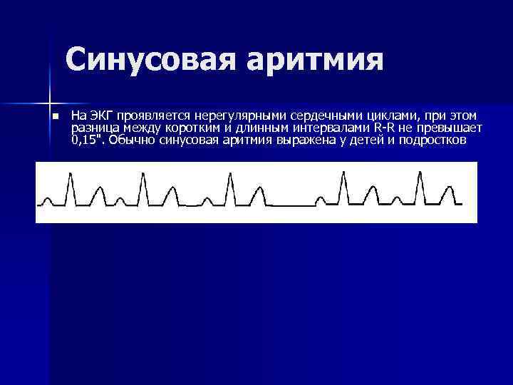 Синусовая аритмия n На ЭКГ проявляется нерегулярными сердечными циклами, при этом разница между коротким