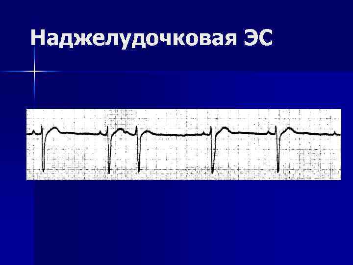 Наджелудочковая ЭС 