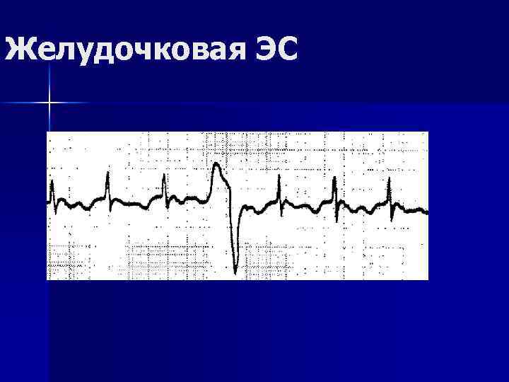 Желудочковая ЭС 