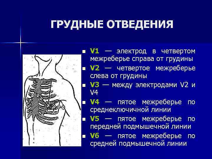 ГРУДНЫЕ ОТВЕДЕНИЯ n n n V 1 — электрод в четвертом межреберье справа от