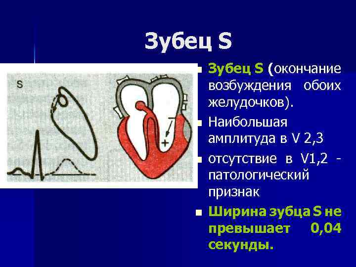 Зубец S n n Зубец S (окончание возбуждения обоих желудочков). Наибольшая амплитуда в V