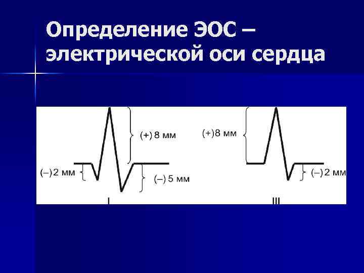 Эл ось экг