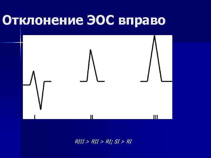 Отклонение ЭОС вправо RIII > RI; SI > RI 