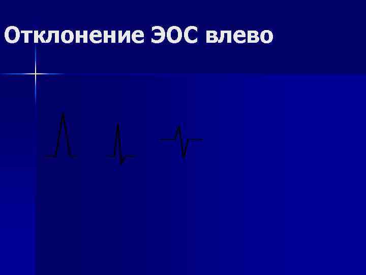 Отклонение ЭОС влево 