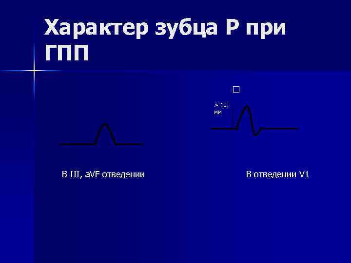 Характер зубца Р при ГПП > 1, 5 мм В III, a. VF отведении