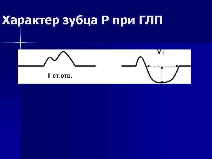Характер зубца Р при ГЛП 