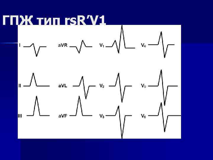 ГПЖ тип rs. R’V 1 