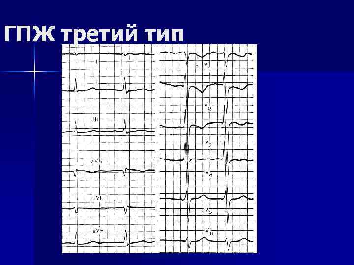ГПЖ третий тип 