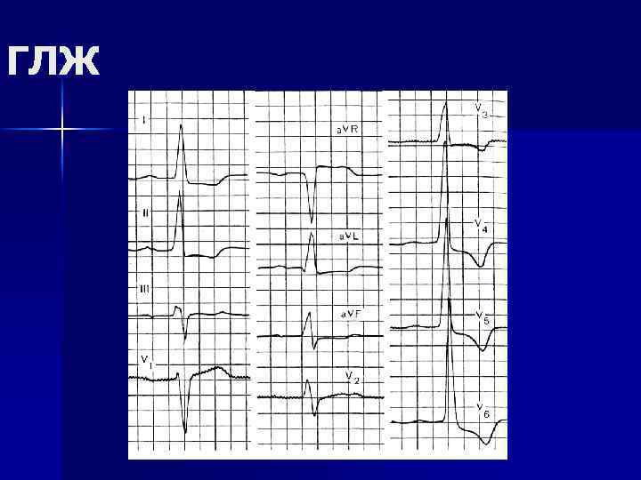 ГЛЖ 