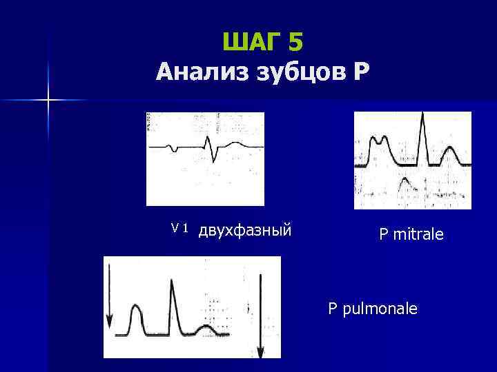 ШАГ 5 Анализ зубцов Р V 1 двухфазный P mitrale P pulmonale 
