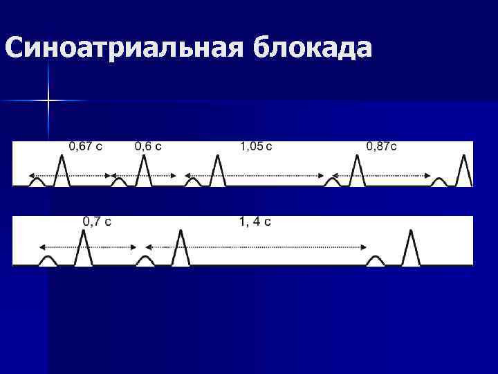Синоатриальная блокада 