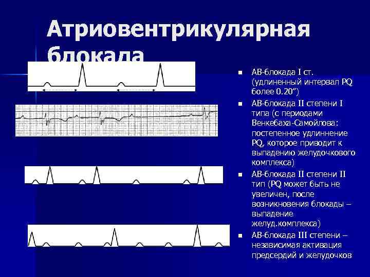 Атриовентрикулярная блокада n n АВ-блокада I ст. (удлиненный интервал PQ более 0. 20”) АВ-блокада