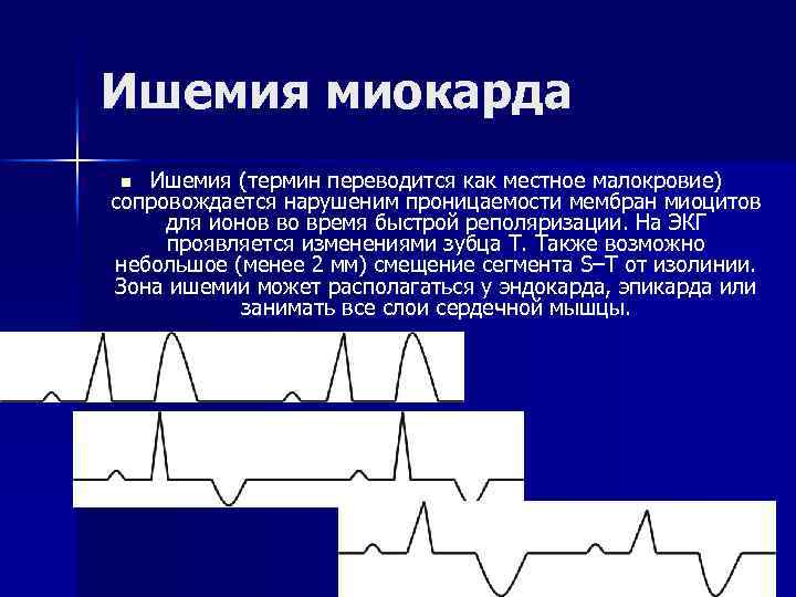 Ишемия миокарда Ишемия (термин переводится как местное малокровие) сопровождается нарушеним проницаемости мембран миоцитов для