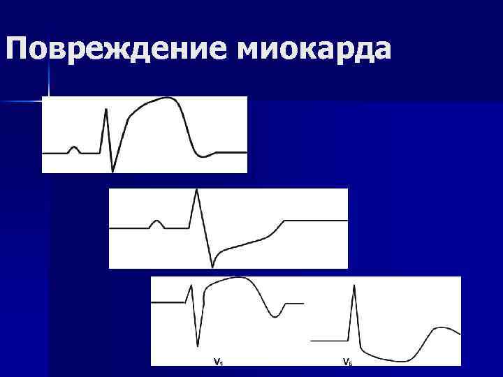 Повреждение миокарда 