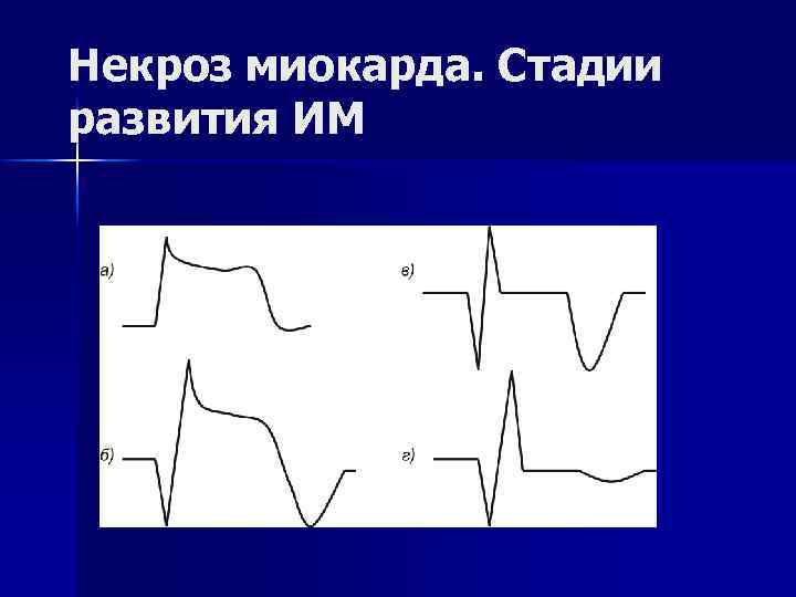Некроз миокарда. Стадии развития ИМ 
