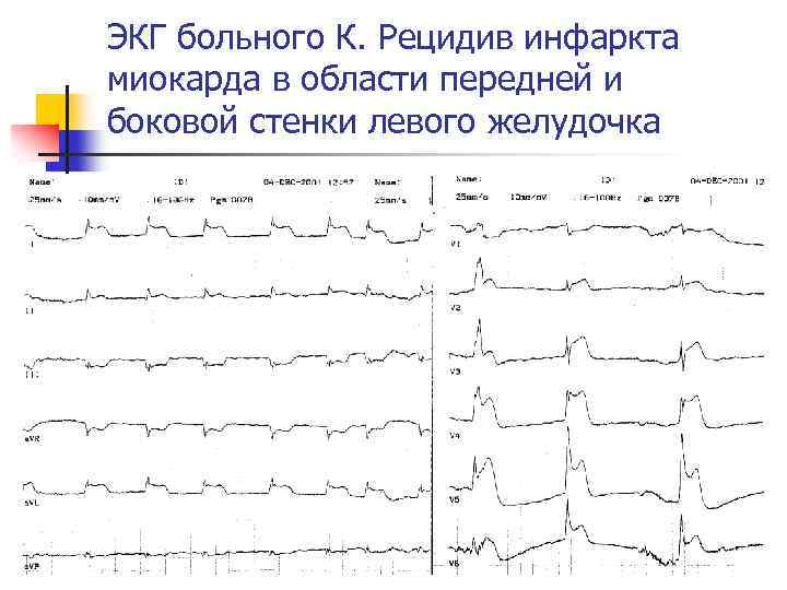 Боковая стенка на экг